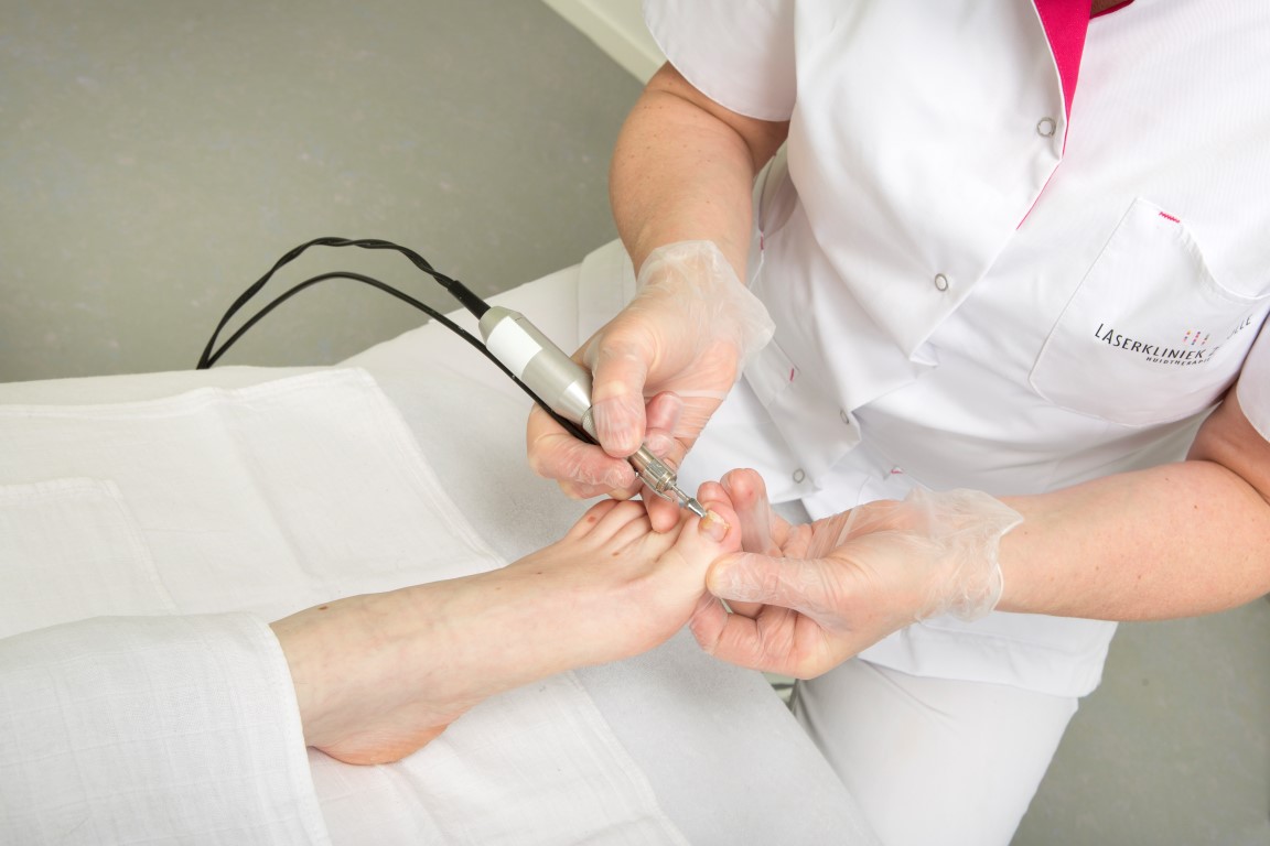 laser ontharen vergoeding