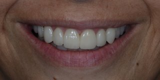 After veneers