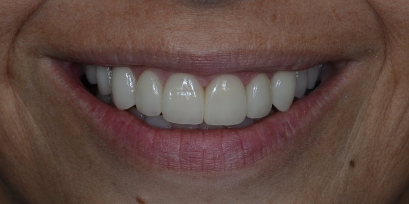 After veneers