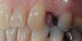 Before dental bridge