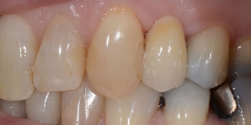 After dental bridge