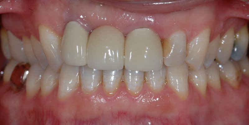 Before dental implants