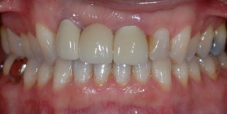 Before dental implants