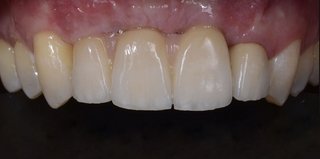After dental implants