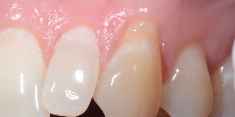Before gum graft
