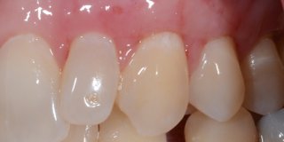 After gum graft