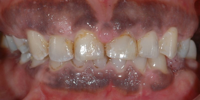 Before aesthetic crown lengthening