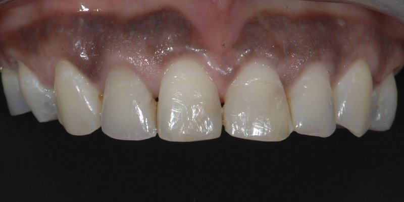 After aesthetic crown lengthening