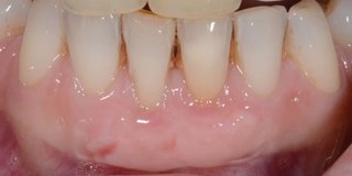 After gum graft