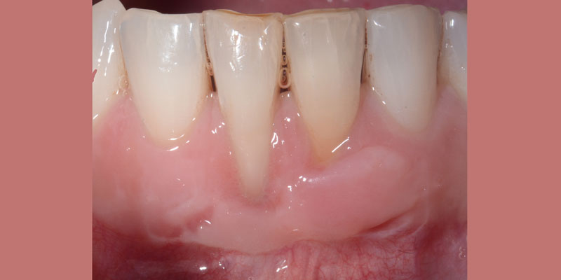 Before gum graft
