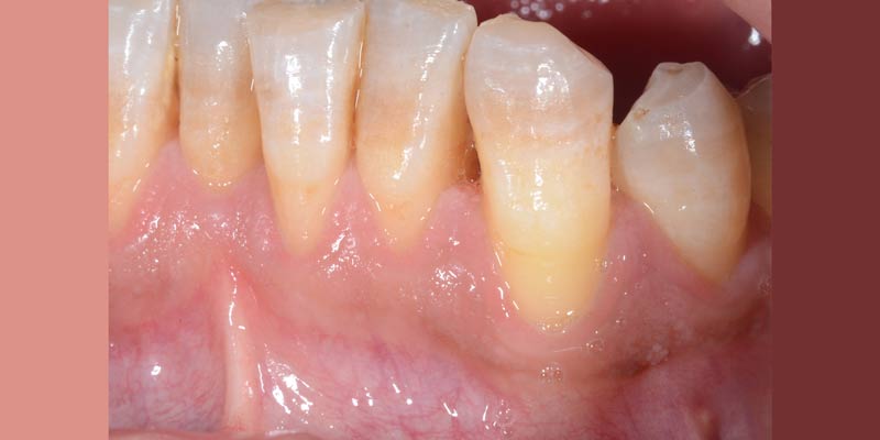 Before gum graft