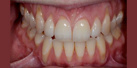 Before gum graft