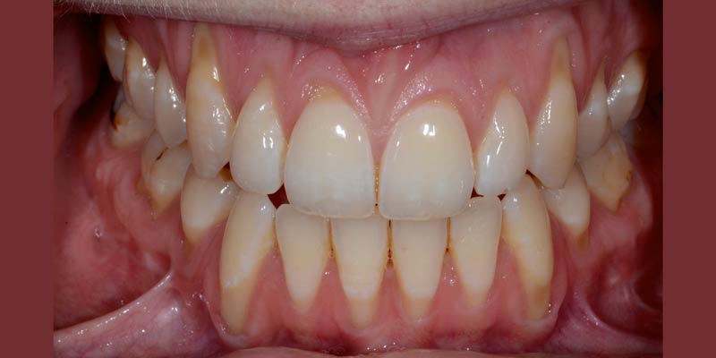 Before gum graft