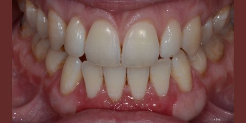 After gum graft