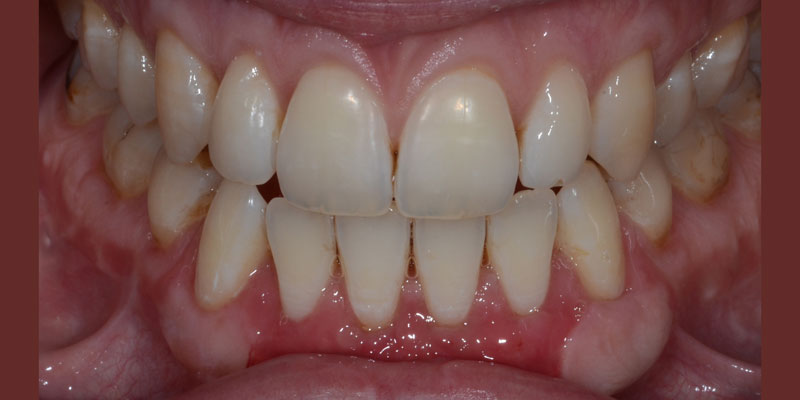 After gum graft