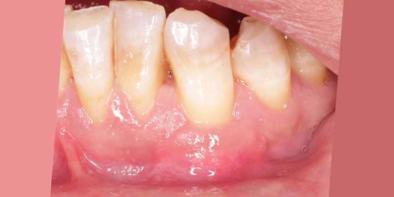 After gum graft