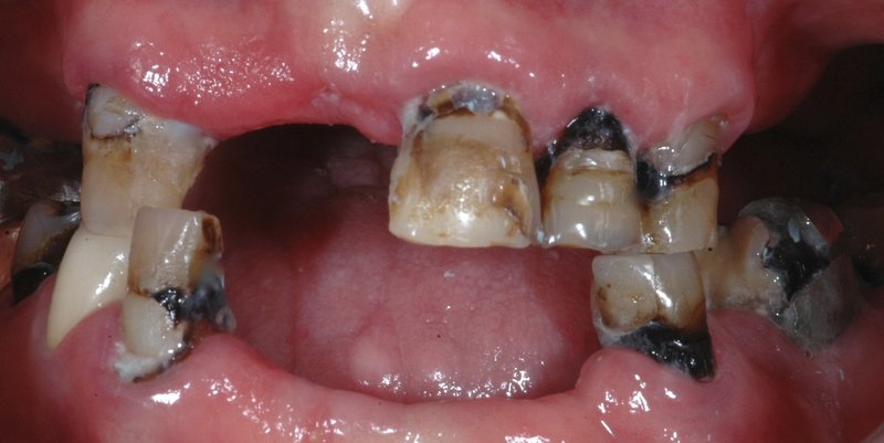 Before Fixed Dentures (All On Four Treatment)