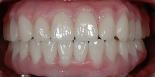 After Fixed Dentures (All On Four Treatment)