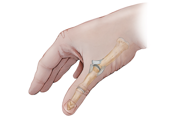 sprained thumb