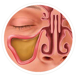 Clogged Sinuses