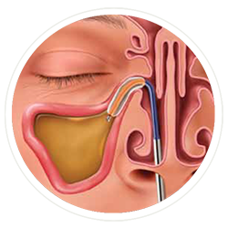 Balloon Sinuplasty Tool Inserted
