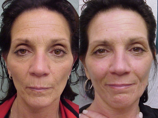 Chemical facial peel recuperation period That Chemical facial peel recuperation period you