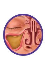 Locate - image of sinus infection
