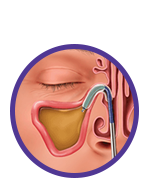 Dilate - the device is placed in the infected area