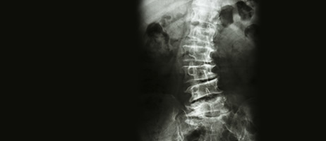 adult scoliosis